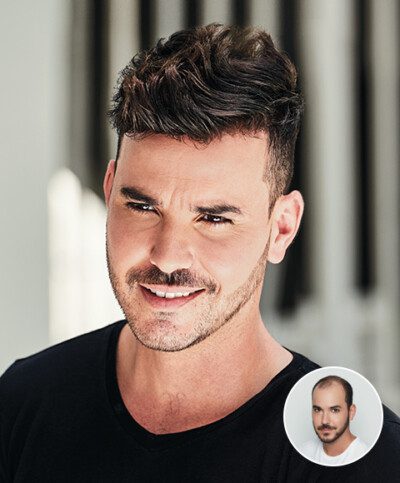 Hair replacement style and coverage example